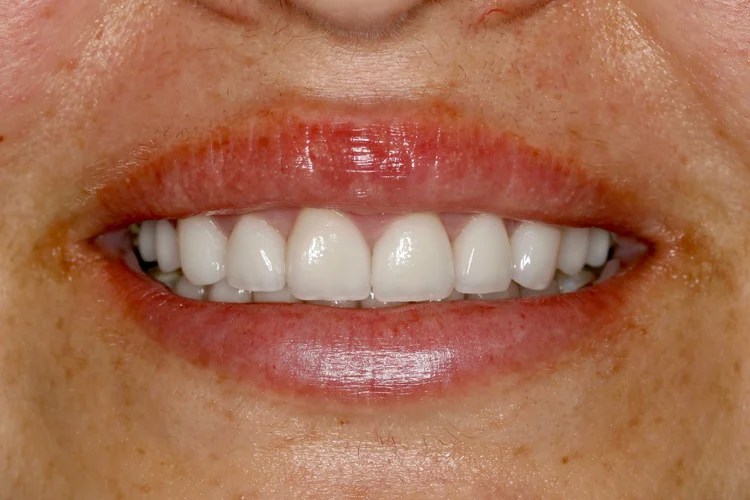 Close-up smile photo showing the after result of a full smile reconstruction with bright, evenly shaped porcelain crowns and healthy gum tissue