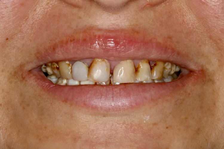 Close-up smile photo showing the before condition featuring severe decay, heavy staining, and broken tooth structure across the upper teeth