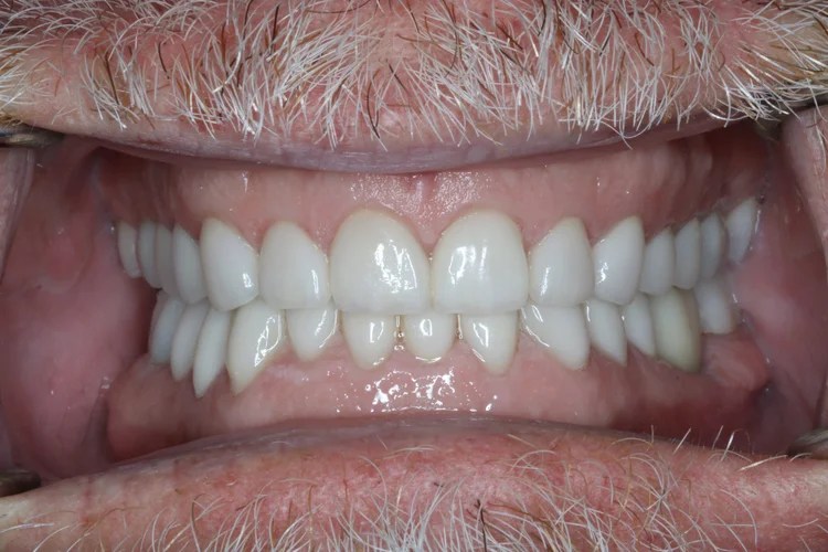 Intraoral close-up photo showing the after result of full upper and lower arch cosmetic dental restorations in perfect occlusion