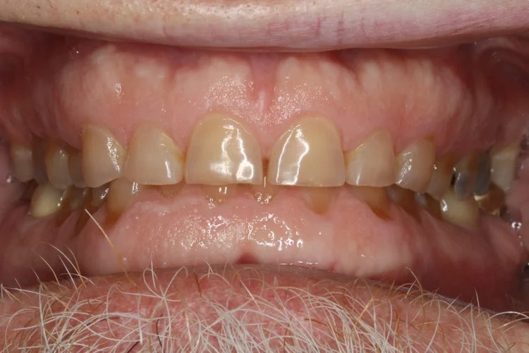 Intraoral close-up photo showing severe tooth wear, discolored enamel, and deep bite collapse on upper and lower teeth prior to restorative dental treatment