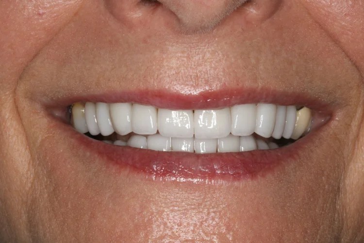 Close-up smile photo showing the after result of full arch veneer restoration featuring bright, perfectly aligned upper teeth