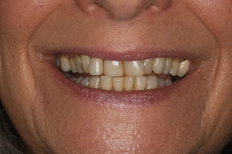 Close-up smile photo showing the before condition with discolored, unevenly spaced, and slightly misaligned teeth