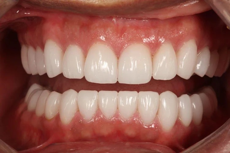 Intraoral close-up photo showing the after result of a full-mouth dental restoration with brightly whitened, symmetrical teeth and healthy gums