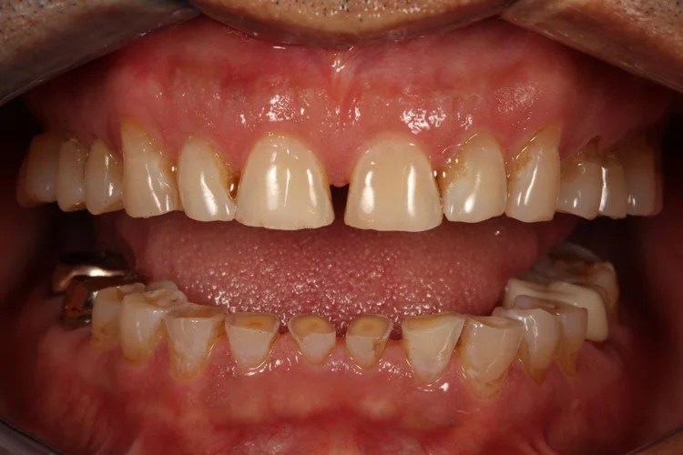 Intraoral close-up photo showing the before condition with significant spacing gaps, uneven wear, and discolored lower teeth