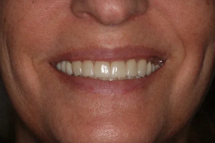 Close-up smile photo showing the after result of cosmetic dental restoration with a clean, straight, natural-looking white smile