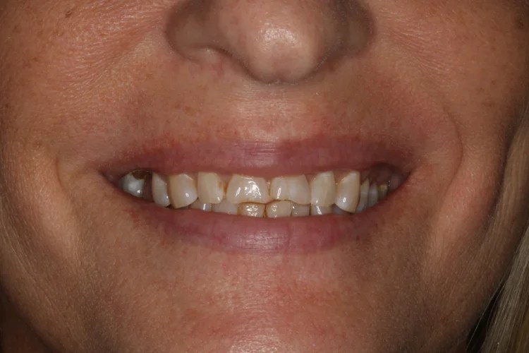 Close-up smile photo showing the before condition with worn, uneven, and chipped front teeth