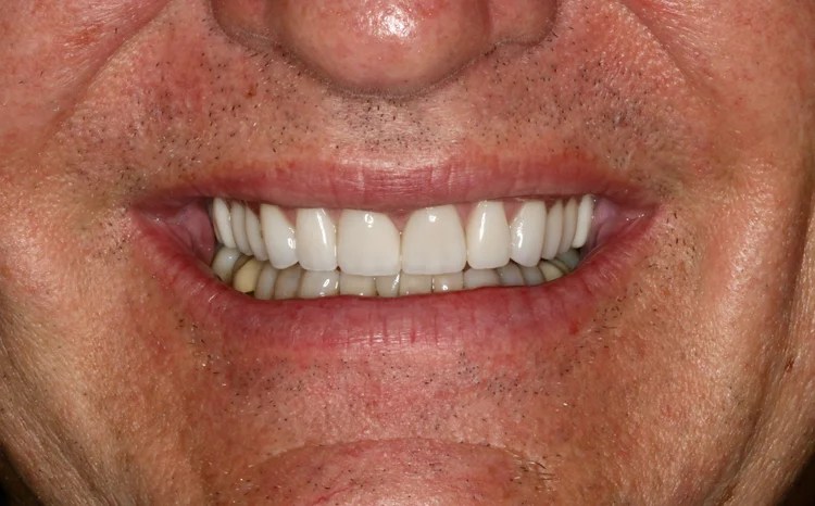 Close-up smile photo showing the after result of a natural cosmetic smile redesign using custom porcelain crowns or veneers