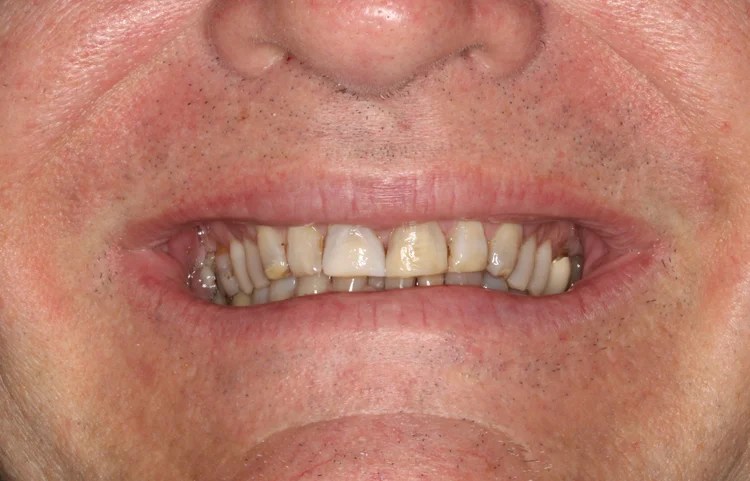 Close-up smile photo showing the before condition with a discolored central incisor crown and uneven dental alignment